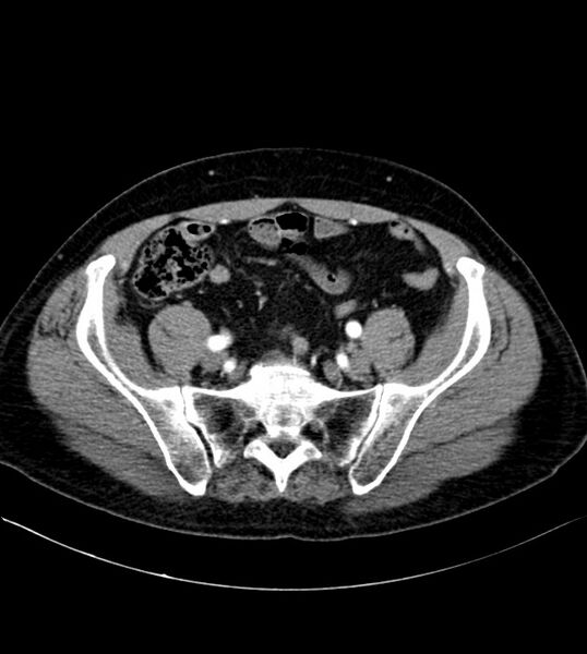 File:Clear cell renal cell carcinoma (Radiopaedia 85006-100539 B 68).jpg