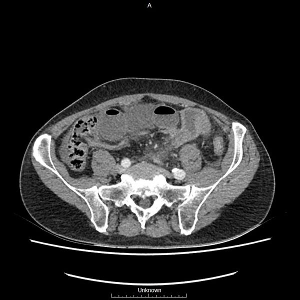 File:Closed loop bowel obstruction and ischemia (Radiopaedia 86959-103180 A 61).jpg