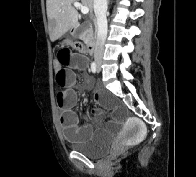 File:Closed loop small bowel obstruction (Radiopaedia 71211-81508 C 62).jpg