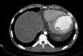 Coarctation of aorta with aortic valve stenosis (Radiopaedia 70463-80574 A 195).jpg