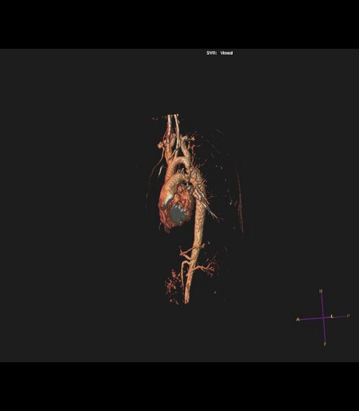 File:Coarctation of the aorta (Radiopaedia 43373-46729 3D reconstruction 17).jpg