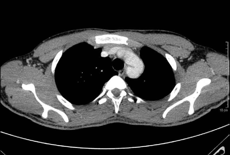 File:Coarctation of the aorta (Radiopaedia 8511-9333 A 1).jpg