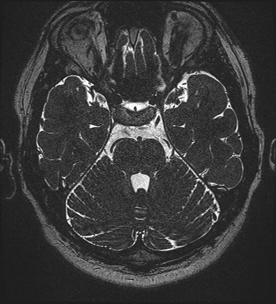 File:Cochlear incomplete partition type III associated with hypothalamic hamartoma (Radiopaedia 88756-105498 Axial T2 113).jpg