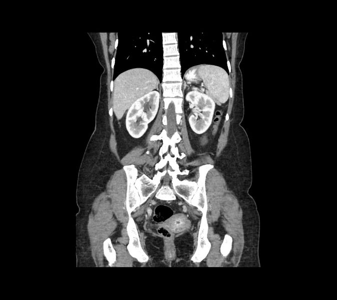 File:Cocoon abdomen with possible tubo-ovarian abscess (Radiopaedia 46235-50636 B 38).jpg