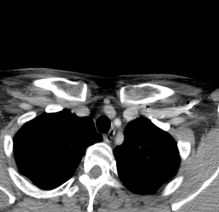 Colloid cyst of thyroid (Radiopaedia 22897-22923 Axial C+ delayed 76).jpg