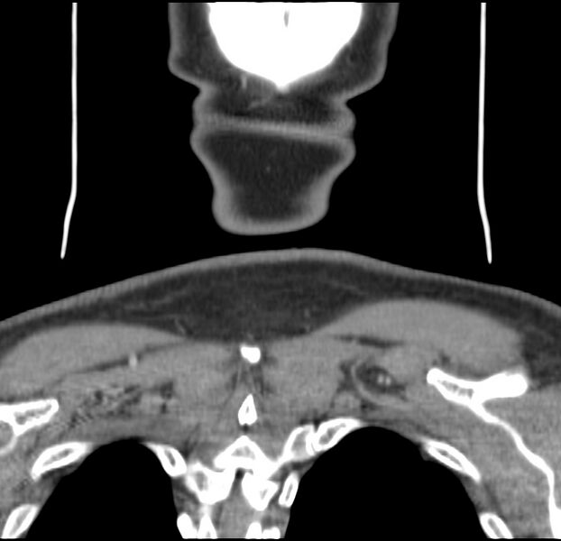 File:Colloid cyst of thyroid (Radiopaedia 22897-22923 Coronal C+ delayed 62).jpg