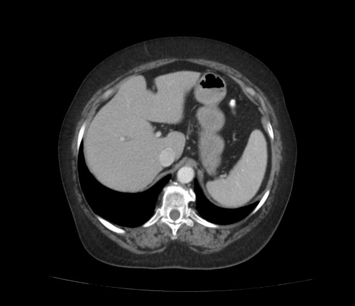 File:Colonic diverticulosis (Radiopaedia 22934-22957 A 15).jpg