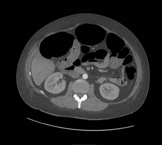 File:Colonic pseudo-obstruction (Radiopaedia 79752-92980 A 83).png