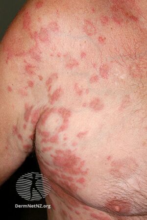 Hypereosinophilic syndrome (DermNet NZ systemic-hypereos1).jpg