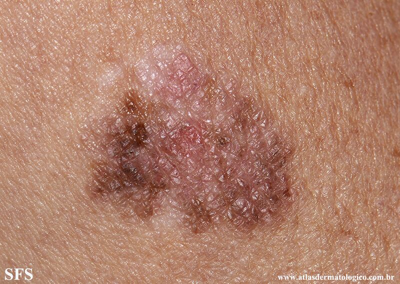 File:Melanoma (Dermatology Atlas 120).jpg