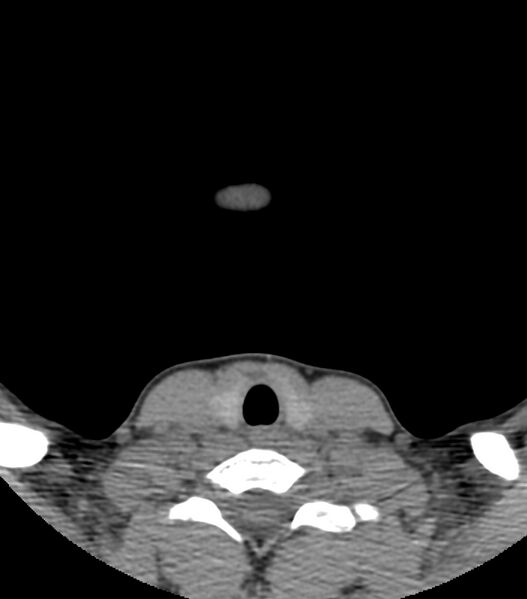 File:Nasoorbitoethmoid fracture (Radiopaedia 90044-107205 Axial non-contrast 2).jpg