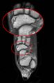 Navicular fracture (Radiopaedia 11662-12025 B 1).jpg