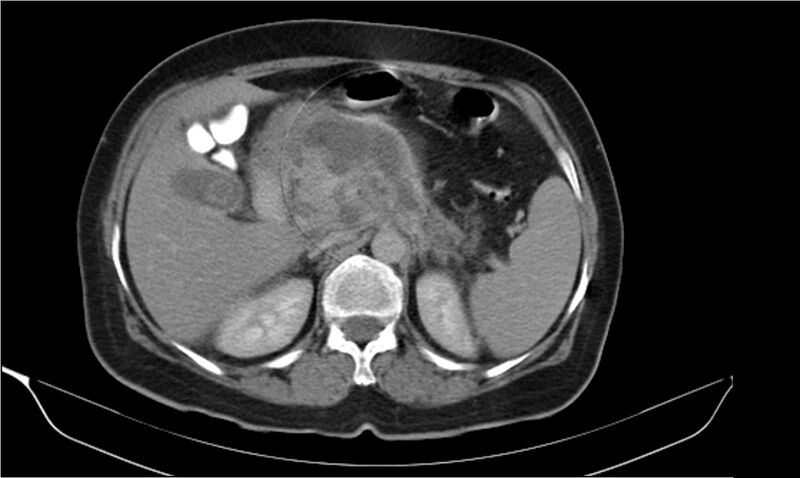 File:Necrotizing pancreatitis (Radiopaedia 20595-20495 Axial C+ delayed 13).jpg