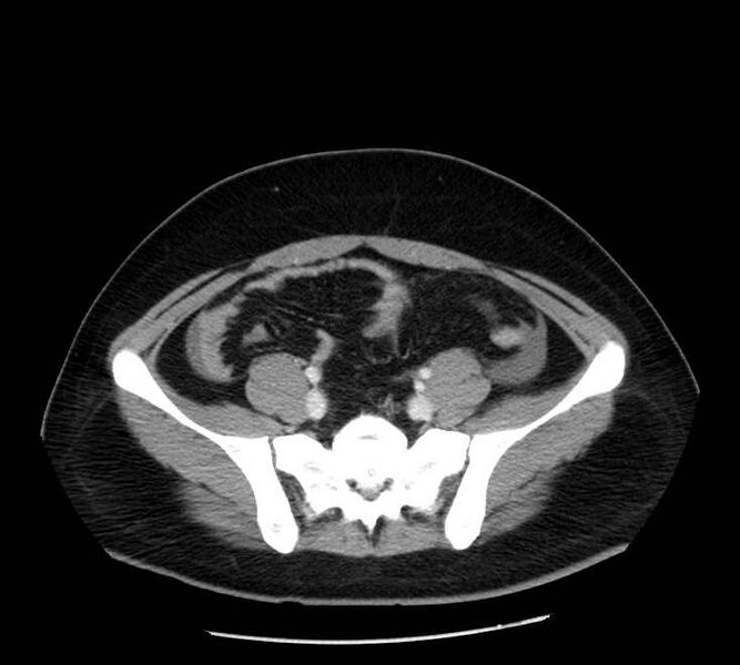 File:Necrotizing pancreatitis (Radiopaedia 23001-23031 A 64).jpg
