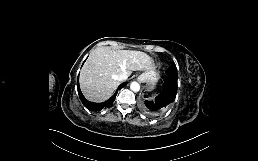 Neo-terminal ileal stricture (Crohn disease) (Radiopaedia 33790-34948 A 57).jpg