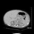 Neonatal neuroblastoma (Radiopaedia 56651-63438 Axial non-contrast 27).jpg