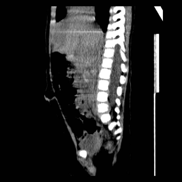 File:Neuroblastoma with skull metastases (Radiopaedia 30326-30960 B 22).jpg