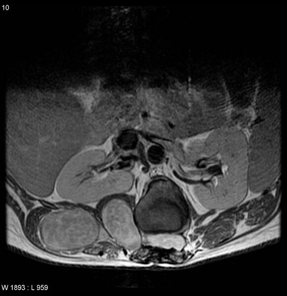 File:Neurofibromatosis type 2 - cranial and spinal involvement (Radiopaedia 5351-7112 Axial T1 C+ 10).jpg