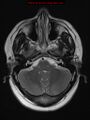 Neuroglial cyst (Radiopaedia 10713-11184 Axial T2 18).jpg