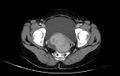 Non-puerperal uterine inversion (Radiopaedia 78343-91094 A 55).jpg