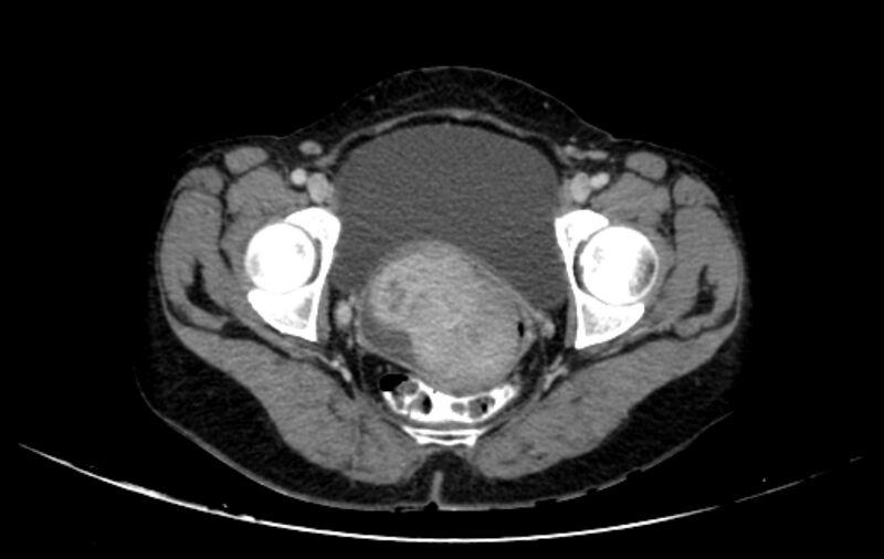 File:Non-puerperal uterine inversion (Radiopaedia 78343-91094 A 55).jpg