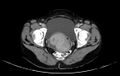 Non-puerperal uterine inversion (Radiopaedia 78343-91094 A 58).jpg