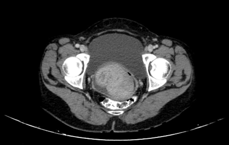 File:Non-puerperal uterine inversion (Radiopaedia 78343-91094 A 58).jpg