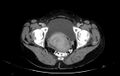 Non-puerperal uterine inversion (Radiopaedia 78343-91094 A 62).jpg