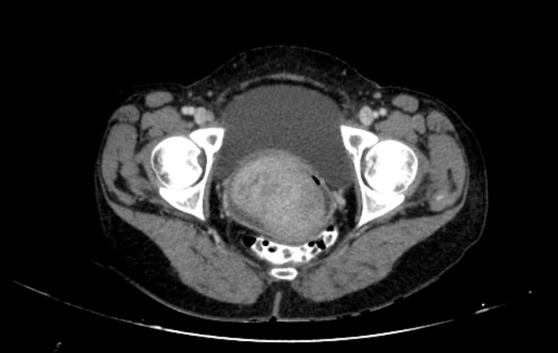 File:Non-puerperal uterine inversion (Radiopaedia 78343-91094 A 62).jpg