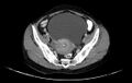 Non-puerperal uterine inversion (Radiopaedia 78343-91094 A 9).jpg