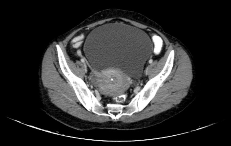 File:Non-puerperal uterine inversion (Radiopaedia 78343-91094 A 9).jpg