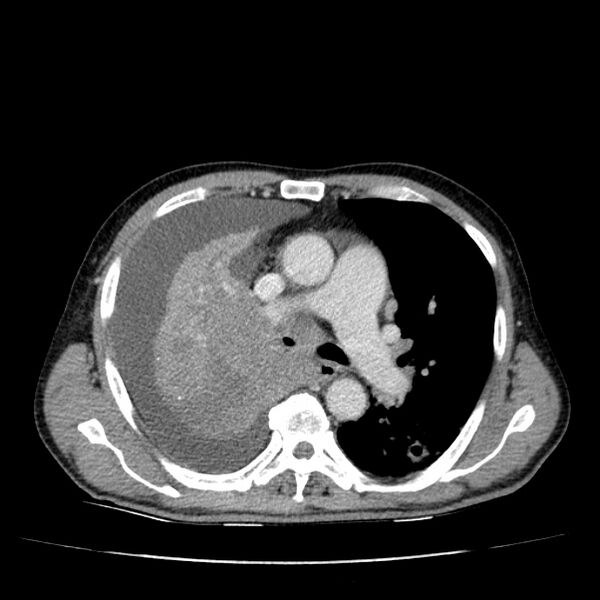 File:Non small-cell lung cancer (Radiopaedia 24467-24769 C+ delayed 27).jpg