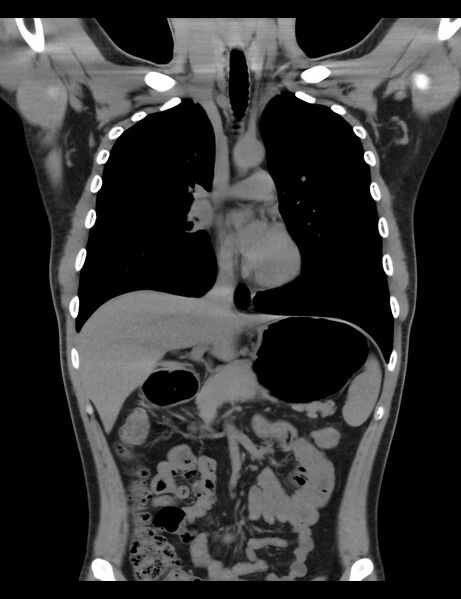 File:Normal CT virtual gastroscopy (Radiopaedia 29960-30501 E 10).jpg