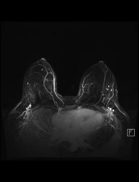 File:Normal breast MRI - dense breasts (Radiopaedia 80454-93850 Axial MIPS 1).jpg