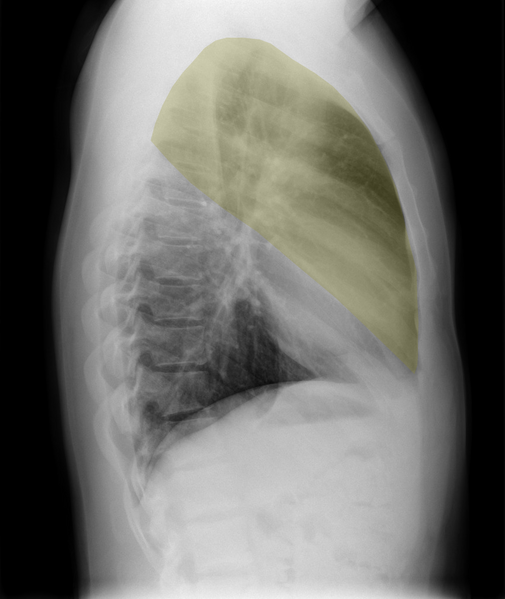 File:Normal chest x-ray - lobes (illustration) (Radiopaedia 58938-66192 E 1).png