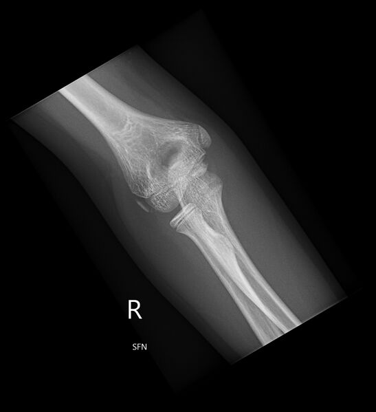 File:Normal elbow xrays - 13-year-old (Radiopaedia 26814-26981 Frontal 1).jpg