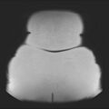 Normal liver MRI with Gadolinium (Radiopaedia 58913-66163 Coronal T2 44).jpg