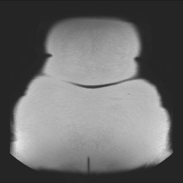 File:Normal liver MRI with Gadolinium (Radiopaedia 58913-66163 Coronal T2 44).jpg