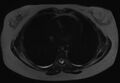 Normal liver MRI with Gadolinium (Radiopaedia 58913-66163 E 35).jpg