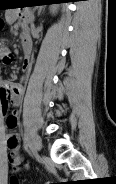 File:Normal lumbar spine CT (Radiopaedia 46533-50986 C 32).png