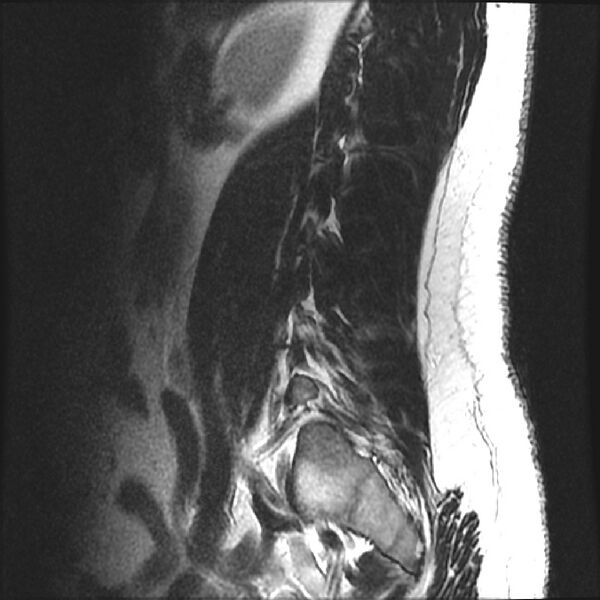 File:Normal lumbar spine MRI (Radiopaedia 43051-46311 Sagittal T2 19).jpg