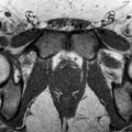Normal prostate (MRI) (Radiopaedia 29986-30535 Axial T1 5).jpg