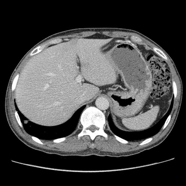 File:Obstructive bladder transitional cell carcinoma (Radiopaedia 9825-10410 A 2).jpg