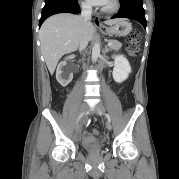 File:Obstructive bladder transitional cell carcinoma (Radiopaedia 9825-10410 B 12).jpg