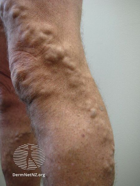 File:Varicose veins (DermNet NZ varicose-veins-01).jpg