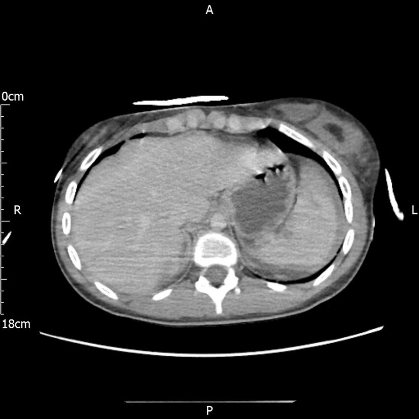 AAST grade IV kidney injury with CEUS follow-up (Radiopaedia 72353-82877 Axial C+ portal venous phase 10).jpg
