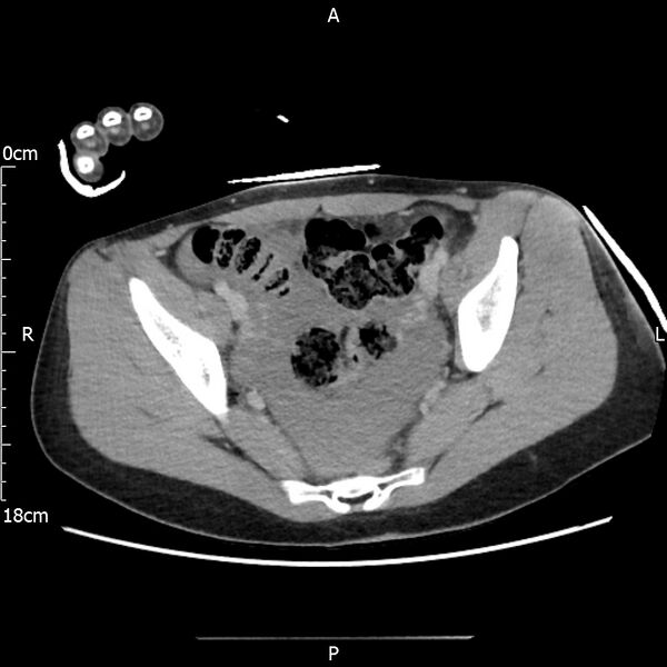 File:AAST grade IV kidney injury with CEUS follow-up (Radiopaedia 72353-82877 Axial C+ portal venous phase 65).jpg