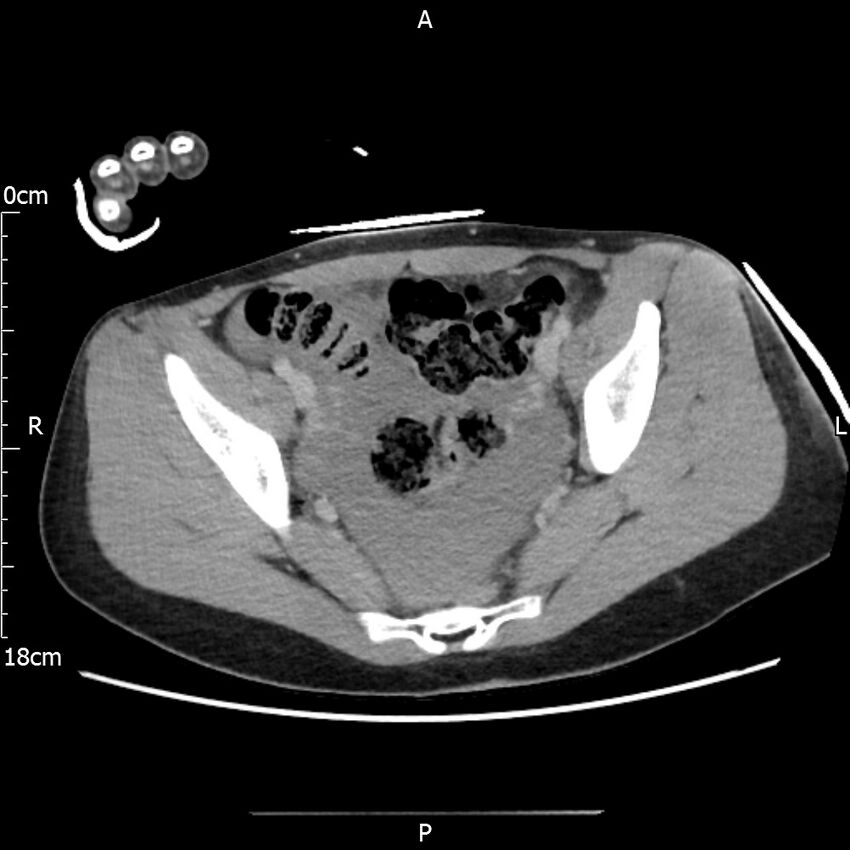 AAST grade IV kidney injury with CEUS follow-up (Radiopaedia 72353-82877 Axial C+ portal venous phase 65).jpg