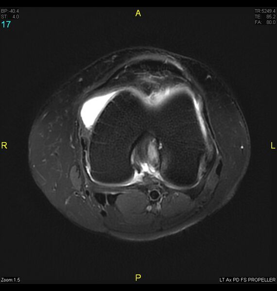 File:ACL mucoid degeration with cystic changes (Radiopaedia 48428-53341 Axial PD fat sat 14).jpg