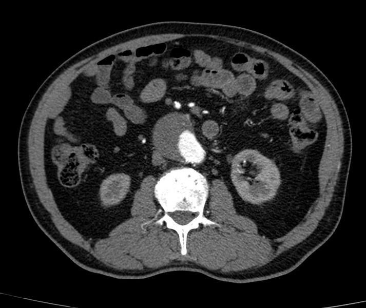 File:Abdominal aortic aneurysm (Radiopaedia 22421-22458 C+ arterial phase 39).jpg